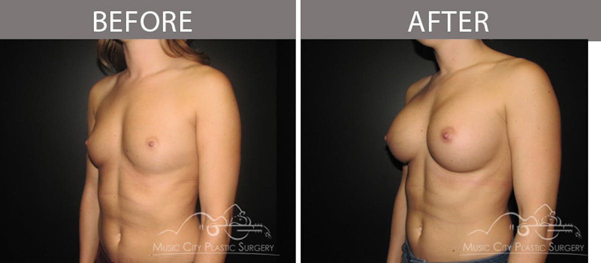 Breast Augmentation Before & After Gallery - Patient 90709384 - Image 2
