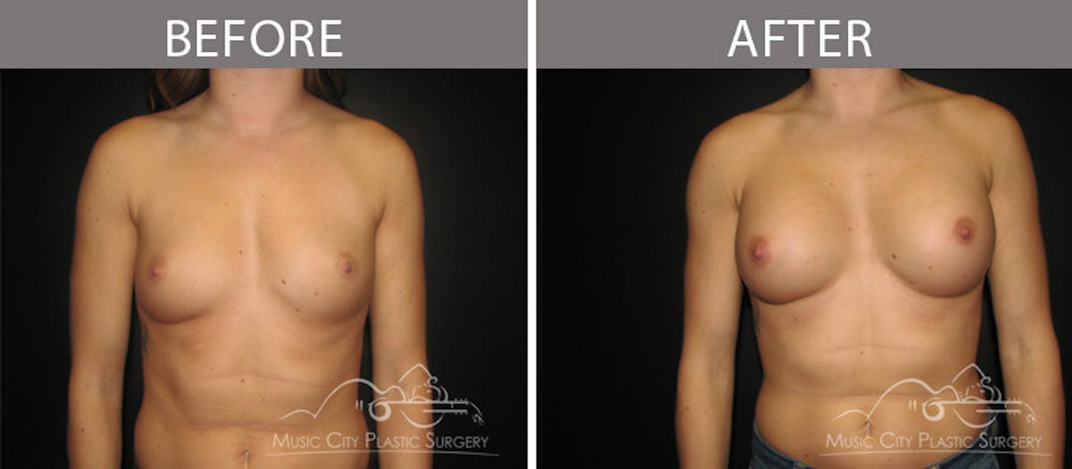 Breast Augmentation Before & After Gallery - Patient 90709384 - Image 1