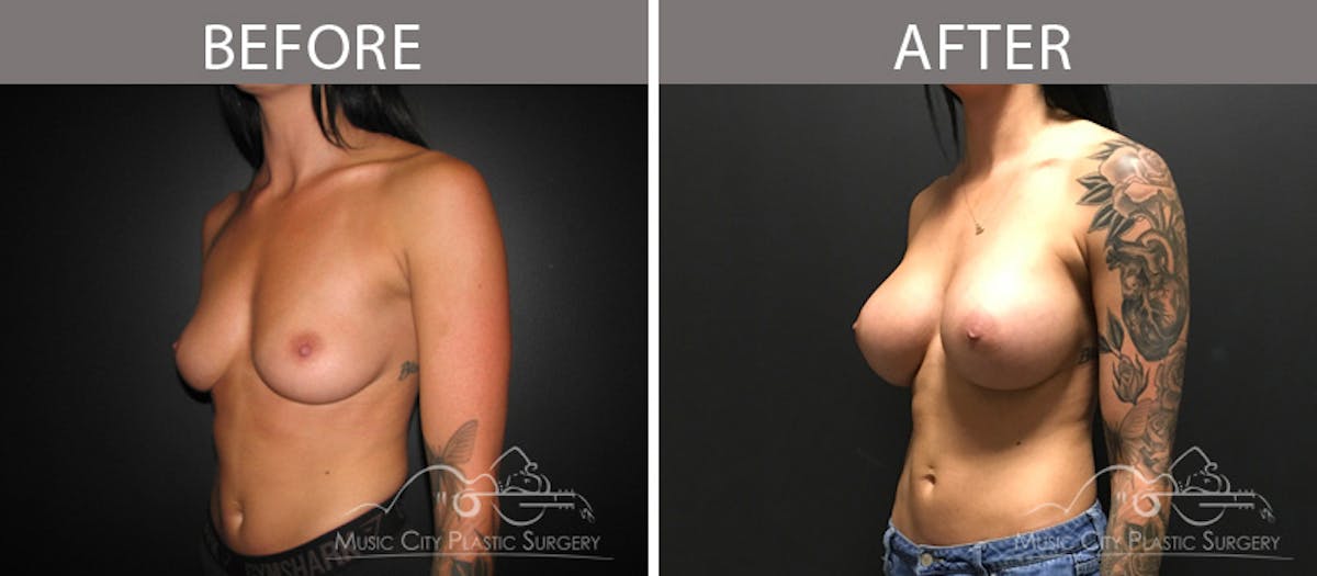 Breast Augmentation Before & After Gallery - Patient 90709387 - Image 2