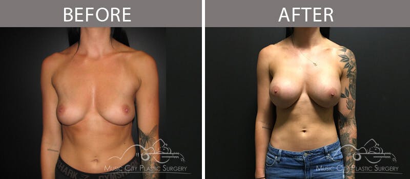 Breast Augmentation Before & After Gallery - Patient 90709387 - Image 2