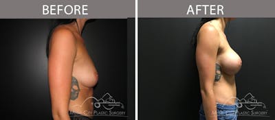 Breast Augmentation Before & After Gallery - Patient 90709387 - Image 3