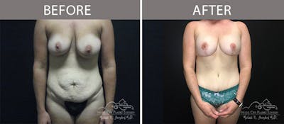 Abdominoplasty Before & After Gallery - Patient 90705113 - Image 1