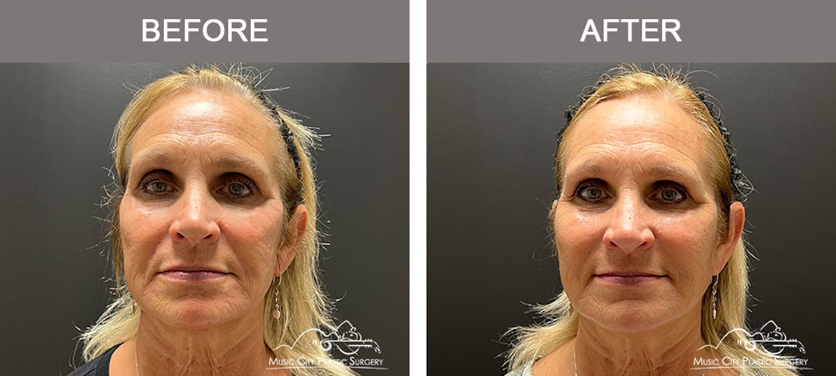 Dermal Fillers Before & After Gallery - Patient 133503153 - Image 1