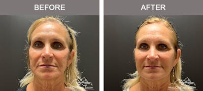 Dermal Fillers Before & After Gallery - Patient 133503153 - Image 1