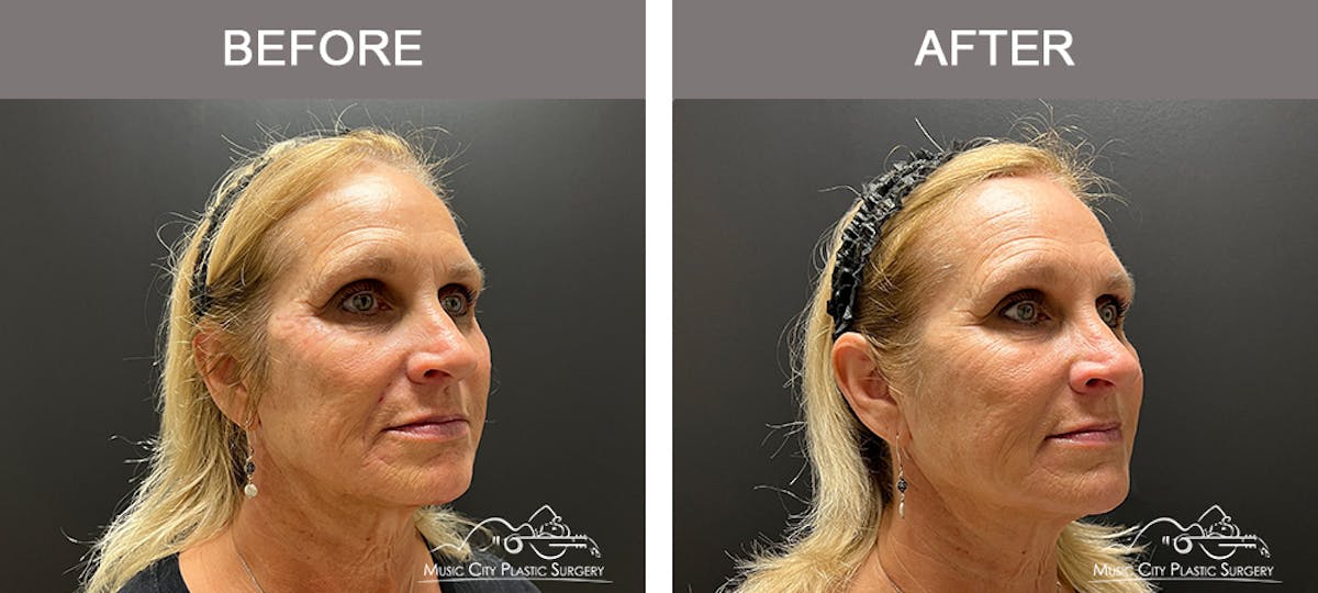 Dermal Fillers Before & After Gallery - Patient 133503153 - Image 2