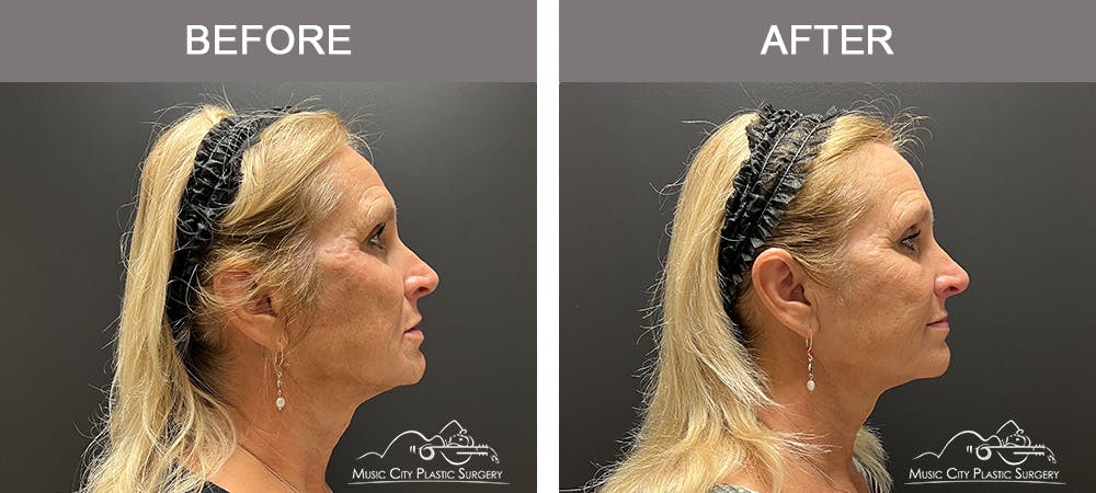 Dermal Fillers Before & After Gallery - Patient 133503153 - Image 3