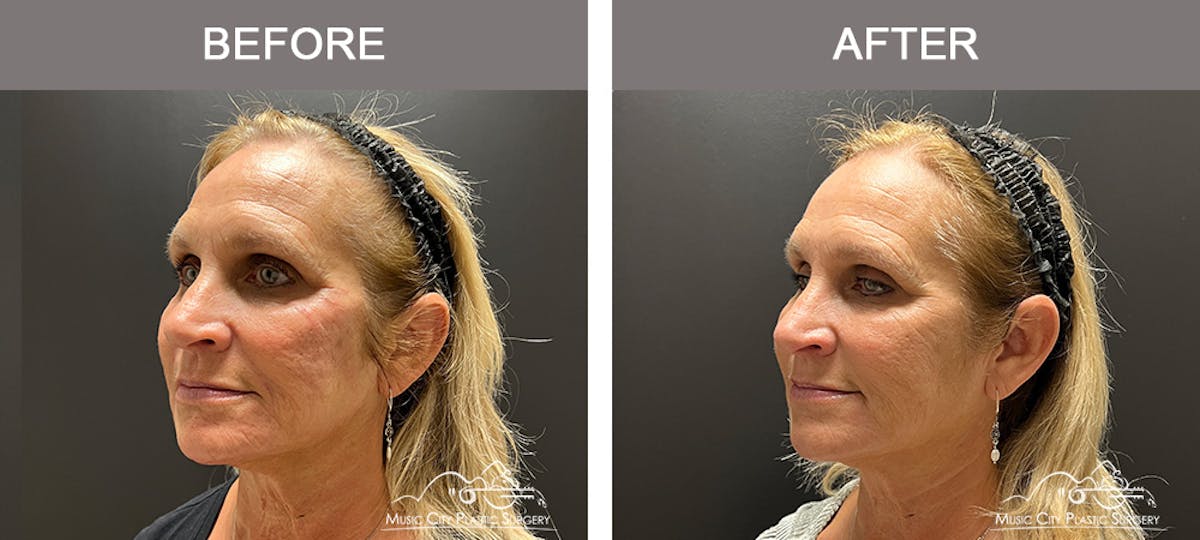 Dermal Fillers Before & After Gallery - Patient 133503153 - Image 4