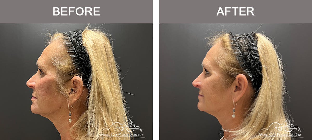 Dermal Fillers Before & After Gallery - Patient 133503153 - Image 5