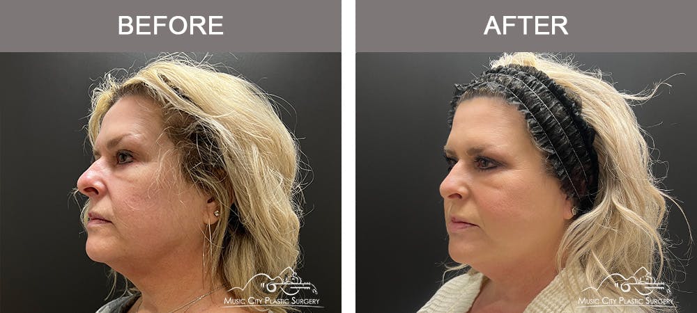 Thread Lifts Before & After Gallery - Patient 133503140 - Image 3