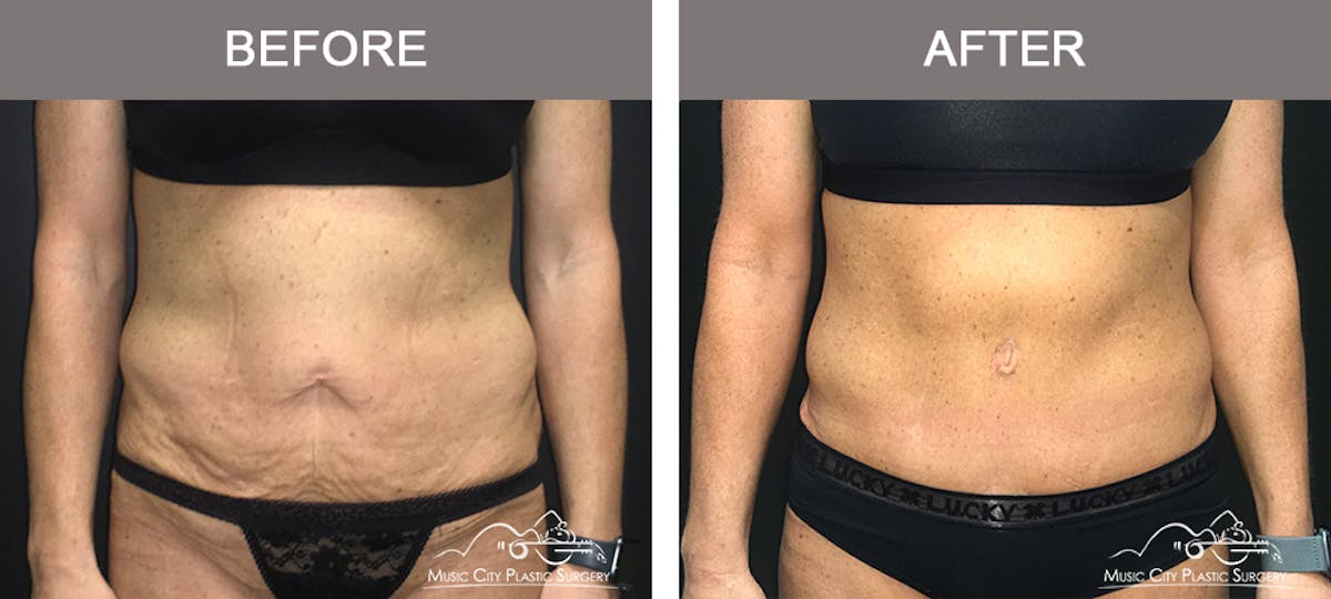 Body Lift Before & After Gallery - Patient 161489463 - Image 1