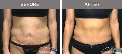 Belt Lipectomy/Body Lift Before & After Gallery - Patient 161489463 - Image 1