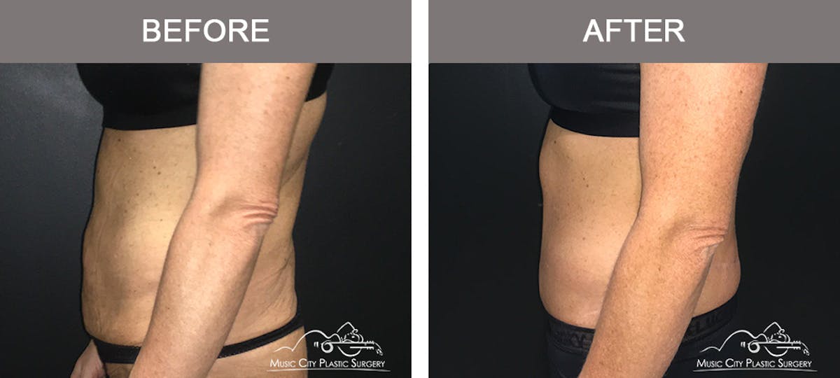 Body Lift Before & After Gallery - Patient 161489463 - Image 3