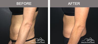 Belt Lipectomy/Body Lift Before & After Gallery - Patient 161489463 - Image 3
