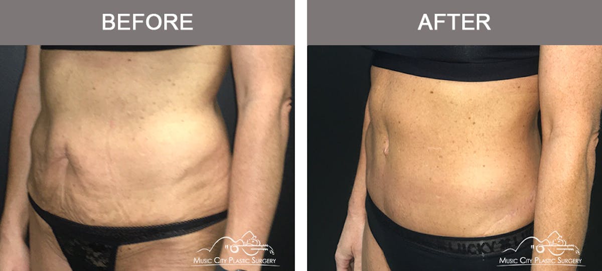 Belt Lipectomy/Body Lift Before & After Gallery - Patient 161489463 - Image 2