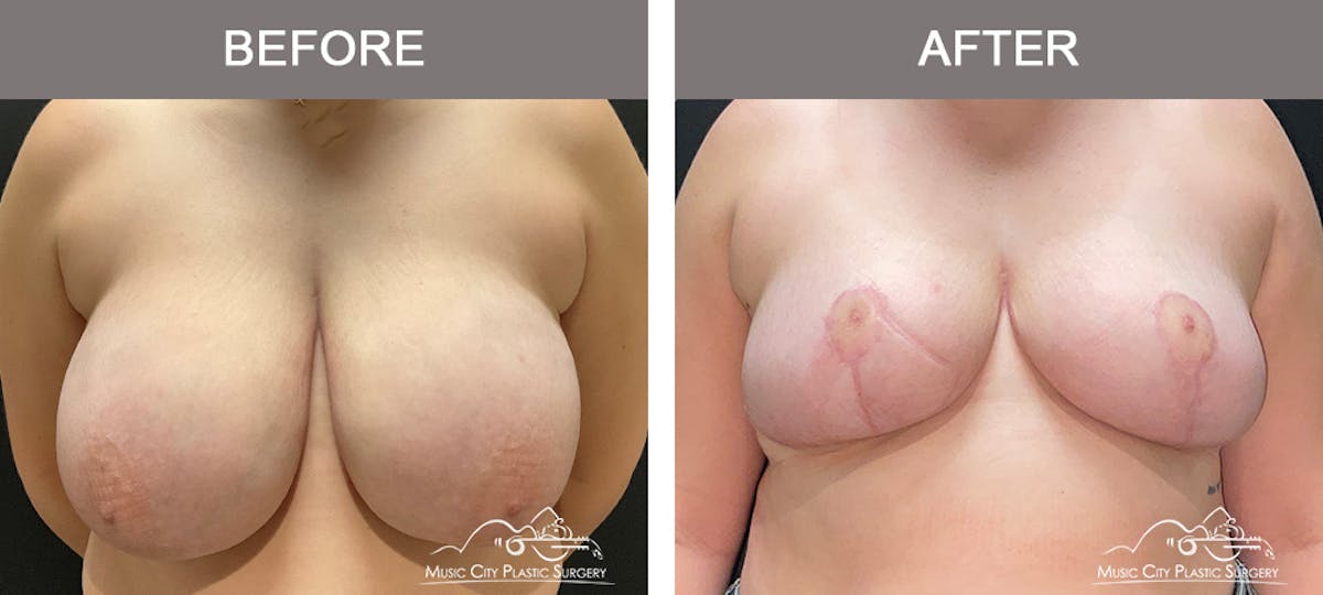 Breast Reduction Before & After Gallery - Patient 161489464 - Image 1