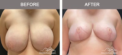 Breast Reduction Before & After Gallery - Patient 161489464 - Image 1