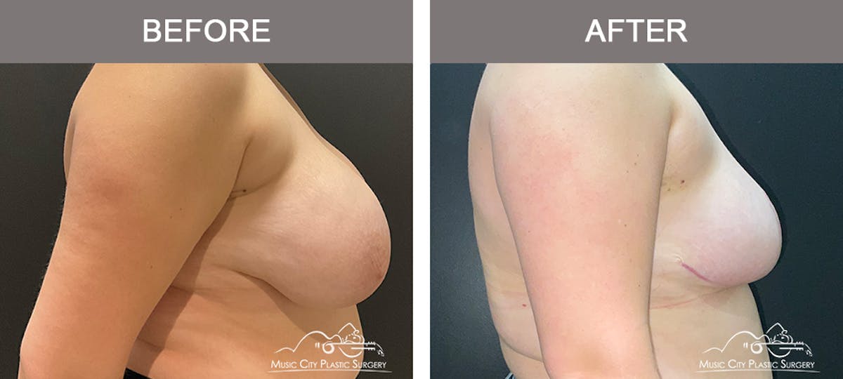 Breast Reduction Before & After Gallery - Patient 161489464 - Image 3