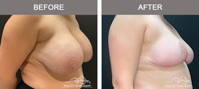 Breast Reduction Before & After Gallery - Patient 161489464 - Image 2
