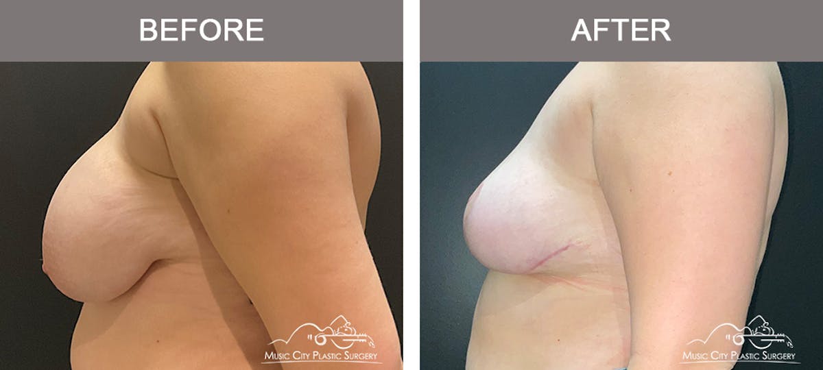 Breast Reduction Before & After Gallery - Patient 161489464 - Image 5