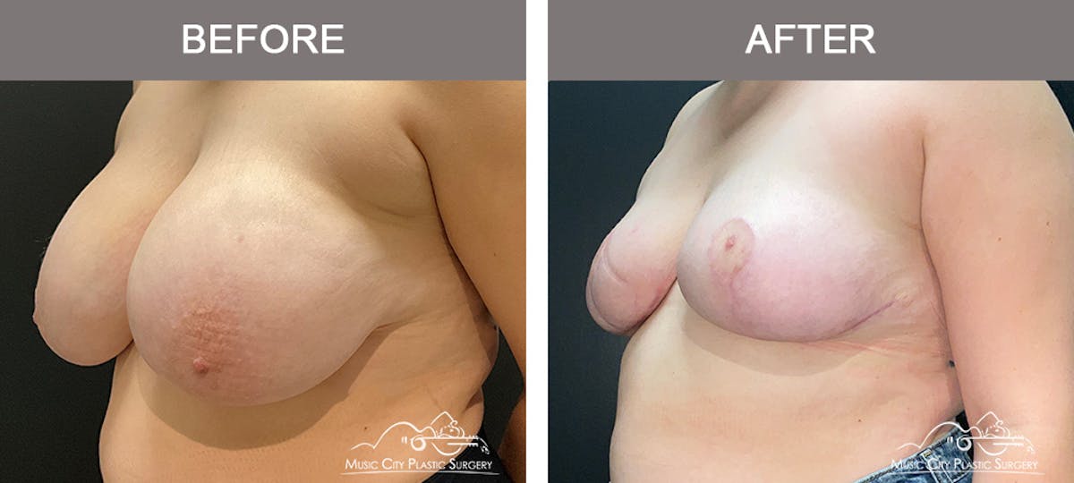 Breast Reduction Before & After Gallery - Patient 161489464 - Image 4