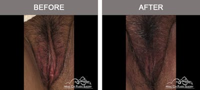 Labiaplasty Before & After Gallery - Patient 161489509 - Image 1