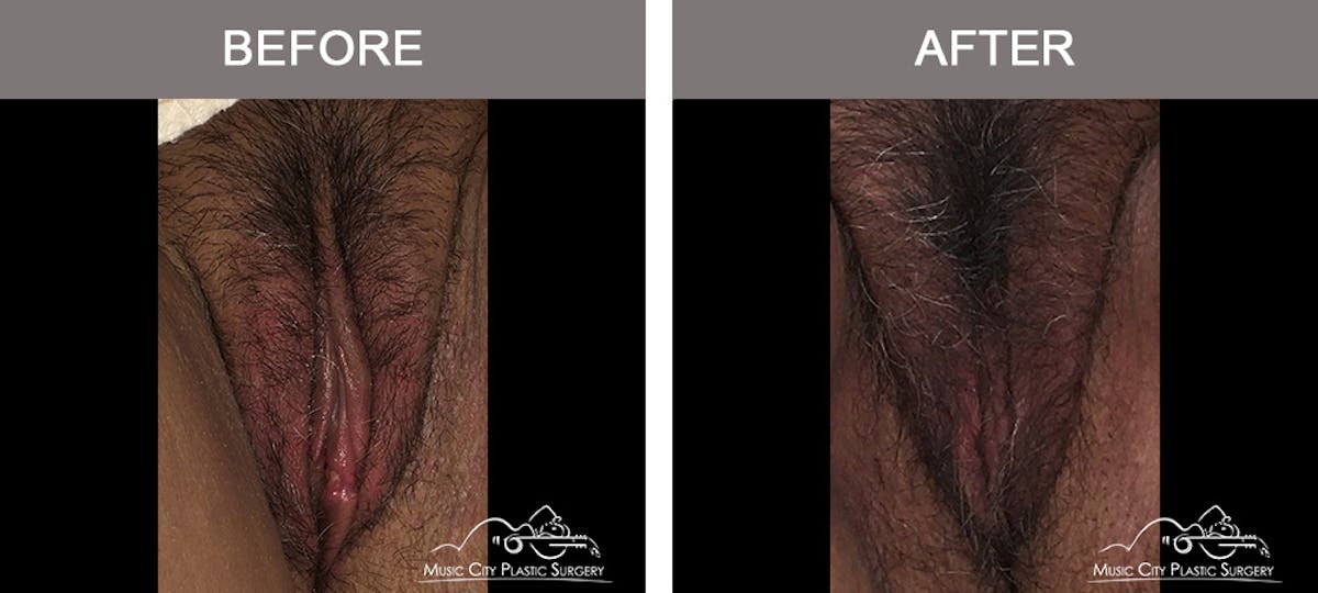 Labiaplasty Before & After Gallery - Patient 161489509 - Image 1
