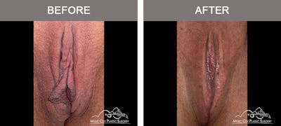 Labiaplasty Before & After Gallery - Patient 161489524 - Image 1