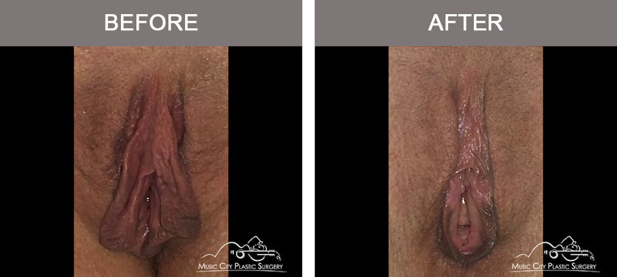 Labiaplasty Before & After Gallery - Patient 161489525 - Image 1