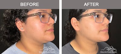 Facial Liposuction Before & After Gallery - Patient 161489470 - Image 1
