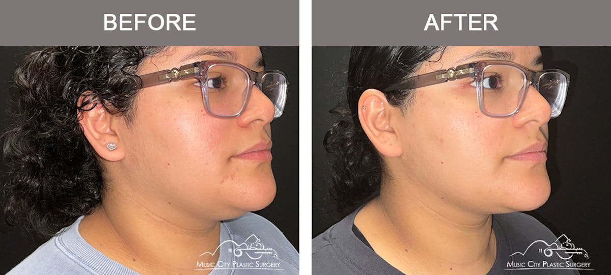 Liposuction Before & After Gallery - Patient 161489470 - Image 1