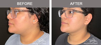 Facial Liposuction Before & After Gallery - Patient 161489470 - Image 3