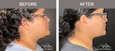 Facial Liposuction Before & After Gallery - Patient 161489470 - Image 2