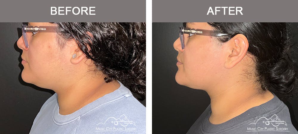 Facial Liposuction Before & After Gallery - Patient 161489470 - Image 4