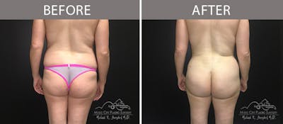 Liposuction Before & After Gallery - Patient 90705078 - Image 2