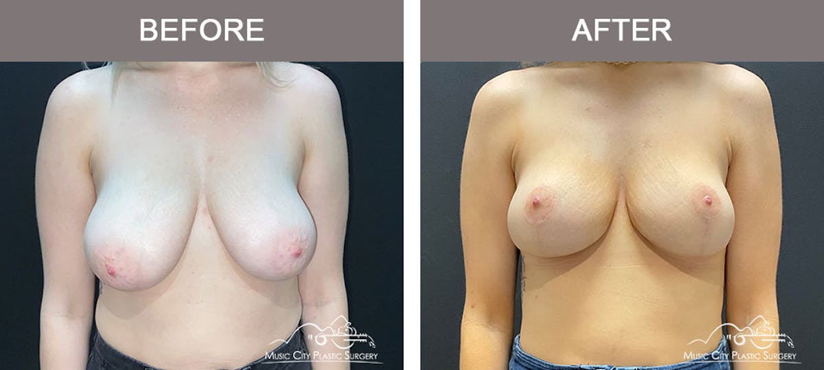 Breast Lift Before & After Gallery - Patient 179397982 - Image 1