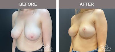 Breast Lift Before & After Gallery - Patient 179397982 - Image 2