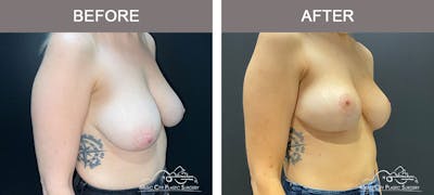 Breast Lift Before & After Gallery - Patient 179397982 - Image 3