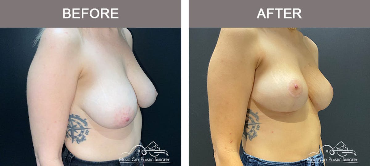 Breast Lift Before & After Gallery - Patient 179397982 - Image 3