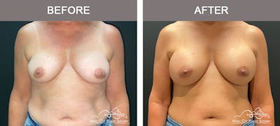 Breast Augmentation Before & After Gallery - Patient 179398950 - Image 1