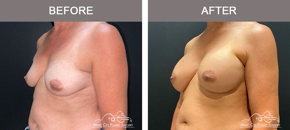 Breast Augmentation Before & After Gallery - Patient 179398950 - Image 2