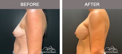 Breast Augmentation Before & After Gallery - Patient 179398950 - Image 3
