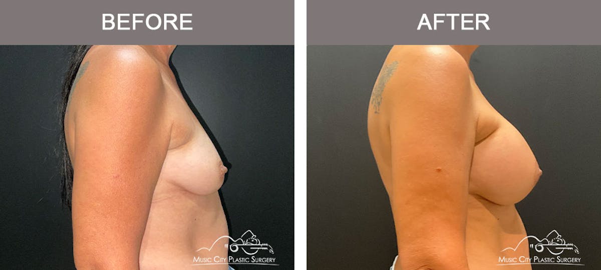 Breast Augmentation Before & After Gallery - Patient 179398950 - Image 4