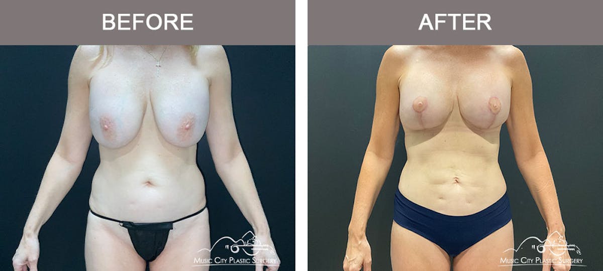 Breast Lift Before & After Gallery - Patient 179398961 - Image 1