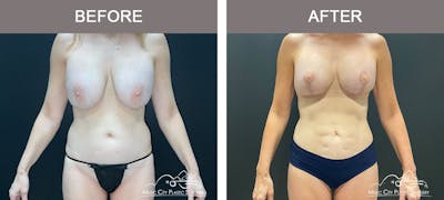 Breast Lift Before & After Gallery - Patient 179398961 - Image 1