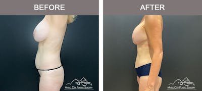 Breast Lift Before & After Gallery - Patient 179398961 - Image 2