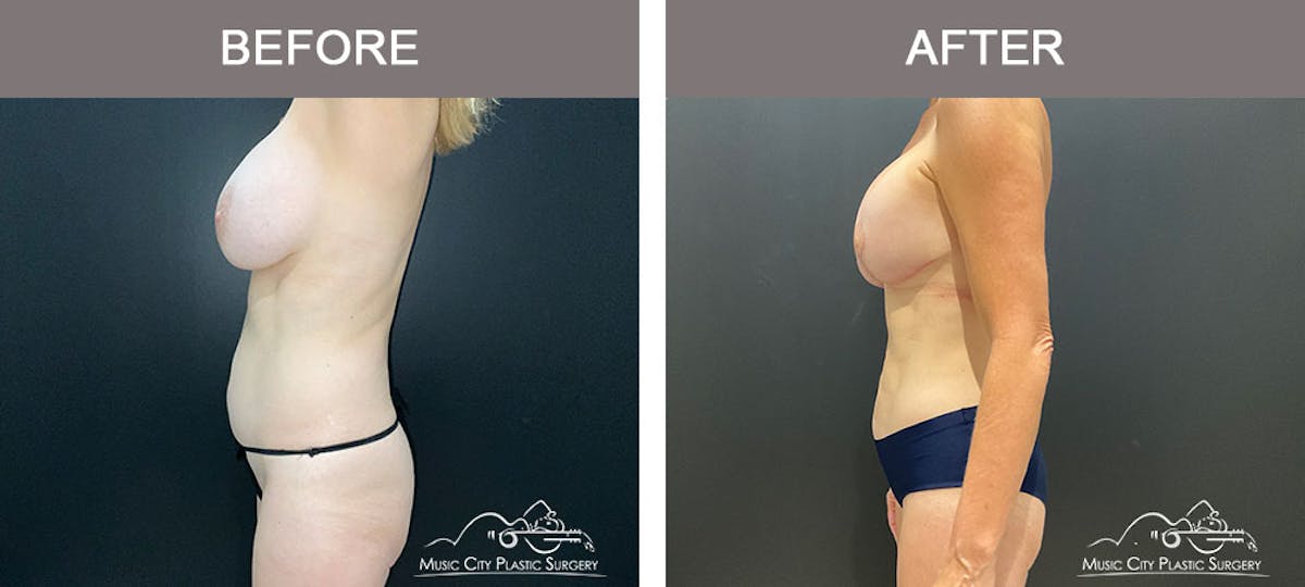Breast Lift Before & After Gallery - Patient 179398961 - Image 2