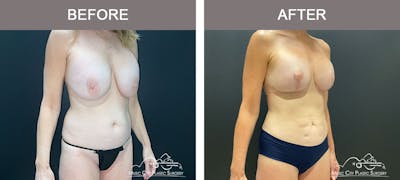Breast Lift Before & After Gallery - Patient 179398961 - Image 3
