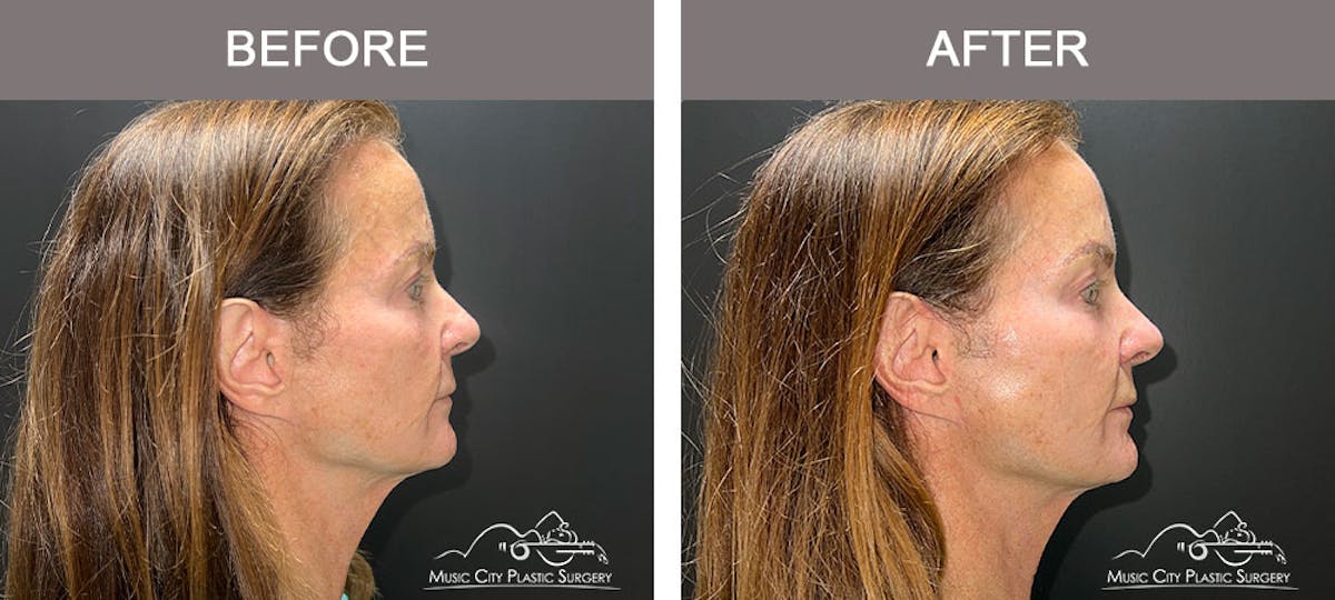 Thread Lifts Before & After Gallery - Patient 179398974 - Image 2