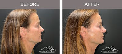 Thread Lifts Before & After Gallery - Patient 179398974 - Image 2