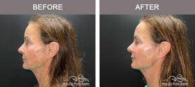Thread Lifts Before & After Gallery - Patient 179398974 - Image 3